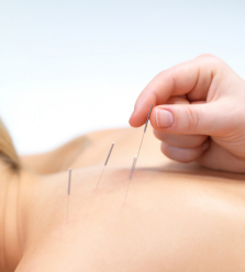 acupuncture